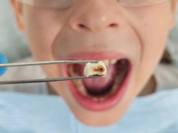 Best Emergency Treatment for Dental Infections or Abscesses in Watseka, IL